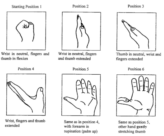 carpal tunnel symptoms. a carpal tunnel exercise