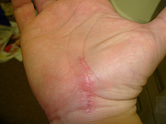 Open carpal tunnel surgery scar