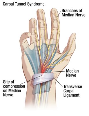 Diagram of Carpal Tunnel Syndrome