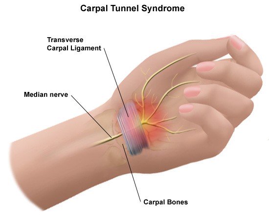 Diagram of Carpal Tunnel Syndrome