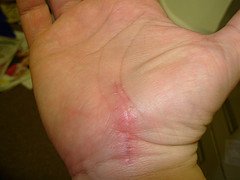 Open carpal tunnel surgery scar