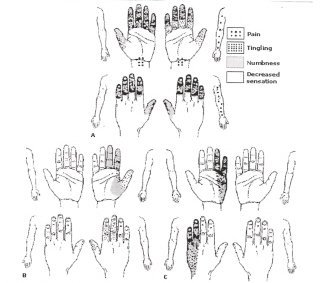 Diagram of various hands, showing areas of pain.